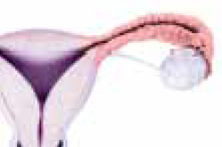 Pelvic inflammatory disease