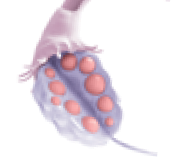 polycysticOvarySyndrome