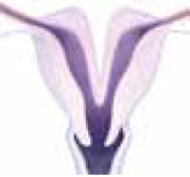 An unusual shape of the uterus