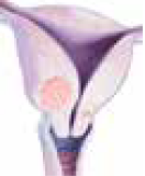 Uterine fibroids