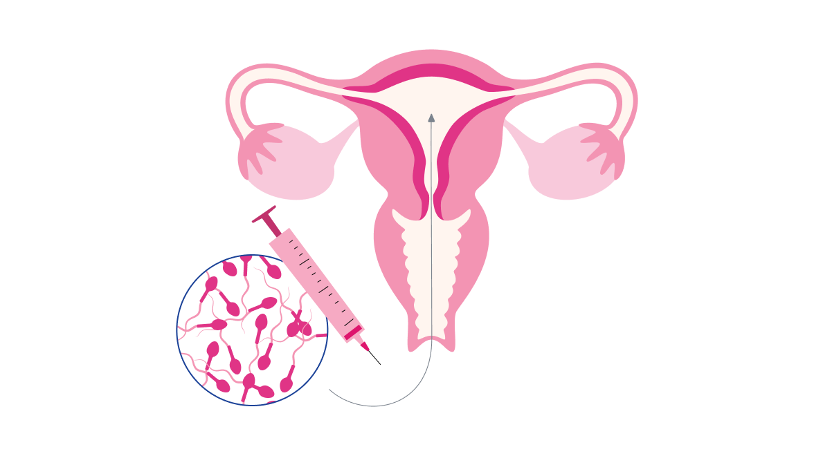IUI illustration